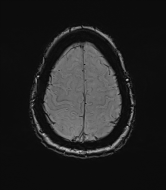 Anterior temporal pole cysts (Radiopaedia 46629-51102 Axial SWI 74).png