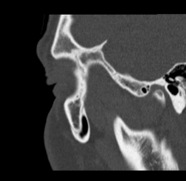 Antrochoanal polyp (Radiopaedia 33984-35202 Sagittal bone window 80).jpg
