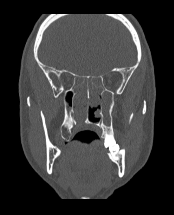 Antrochoanal polyp (Radiopaedia 79011-92169 Coronal bone window 36).jpg