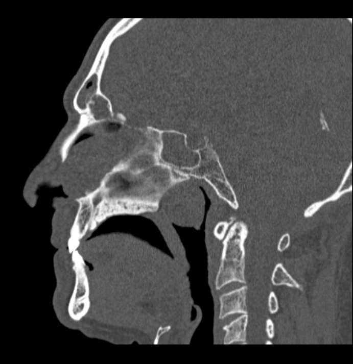 Antrochoanal polyp (Radiopaedia 79011-92169 Sagittal bone window 30).jpg