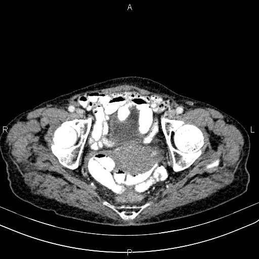 File:Aortic aneurysm and Lemmel syndrome (Radiopaedia 86499-102554 A 73).jpg