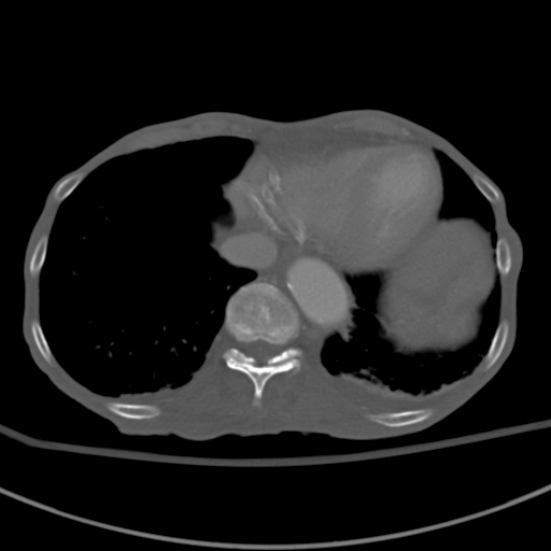 Aortic aneurysm with spinal destruction (Radiopaedia 42301-45410 Axial bone window 7).jpg
