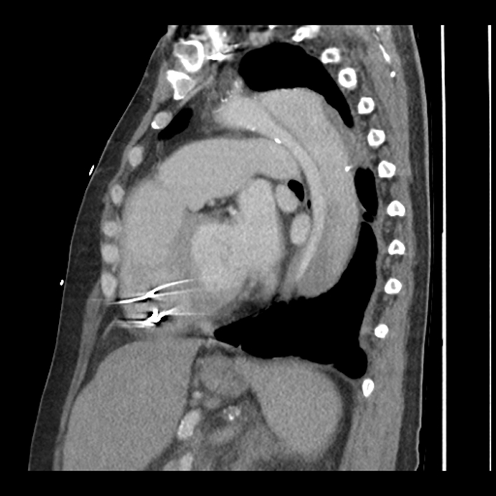 Aortic arch graft infection (FDG PET-CT) (Radiopaedia 71975-82437 C 43).jpg