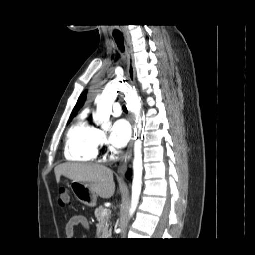 File:Aortic arch stent (Radiopaedia 30030-30595 E 9).jpg