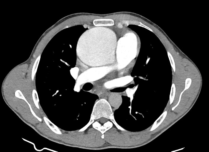 File:Aortic coarctation with aneurysm (Radiopaedia 74818-85828 A 119).jpg