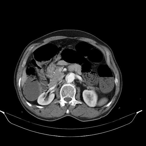Aortic dissection- Stanford type A (Radiopaedia 22085-22085 A 46).jpg