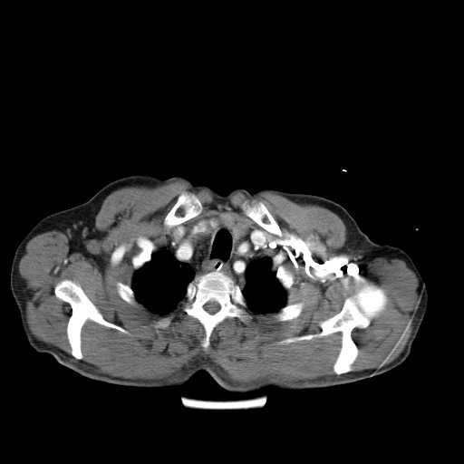 Aortic dissection- Stanford type A (Radiopaedia 22085-22085 A 8).jpg
