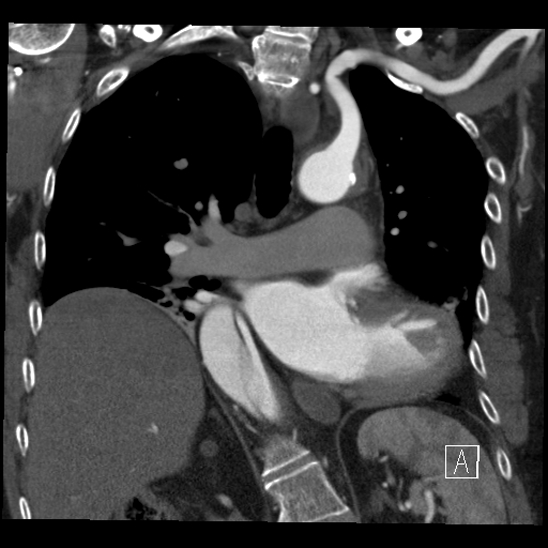 Aortic dissection (CTPA) (Radiopaedia 75506-86750 B 39).jpg