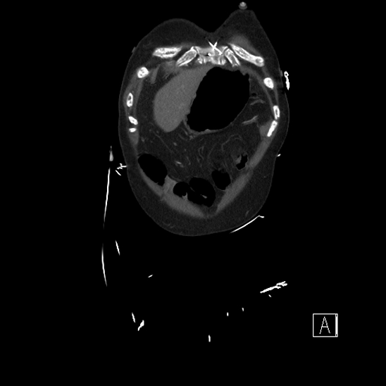 Aortic dissection (CTPA) (Radiopaedia 75506-86750 F 1).jpg