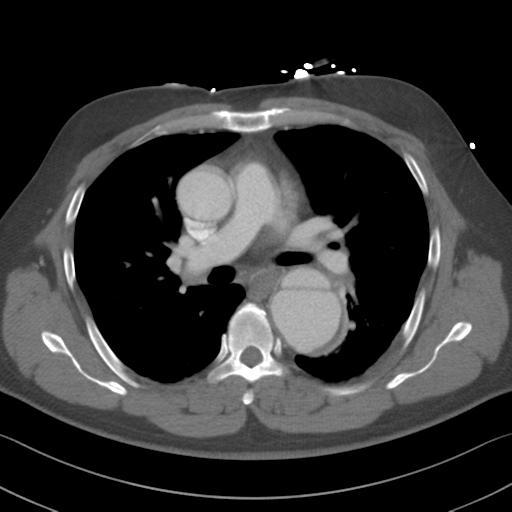 Aortic dissection (Radiopaedia 50763-56234 A 27).png