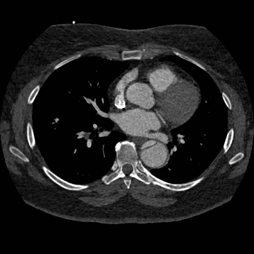 Aortic dissection (Radiopaedia 57969-64959 A 171).jpg