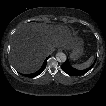 Aortic dissection (Radiopaedia 57969-64959 A 257).jpg