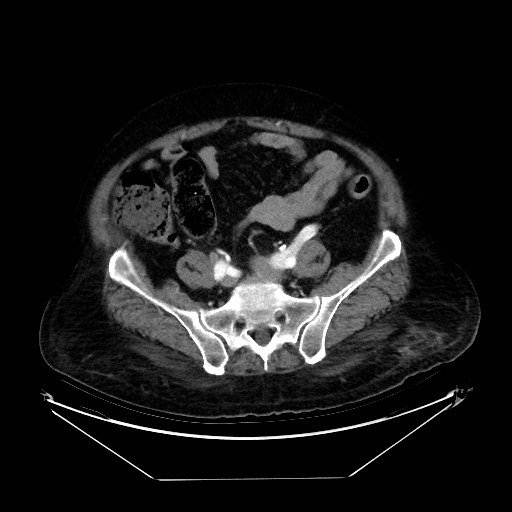 Aortic dissection (Radiopaedia 62562-71000 A 89).jpg