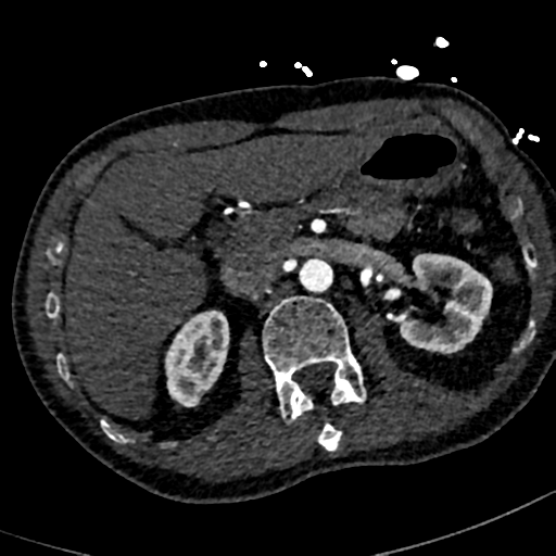 File:Aortic dissection - DeBakey type II (Radiopaedia 64302-73082 A 98).png