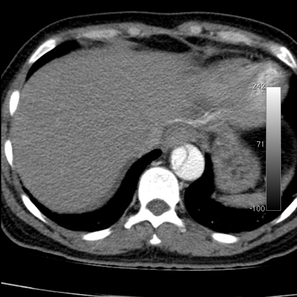 Aortic dissection - Stanford type A (Radiopaedia 29247-29659 A 64).jpg