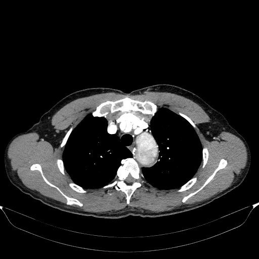 Aortic dissection - Stanford type A (Radiopaedia 83418-98500 A 16).jpg