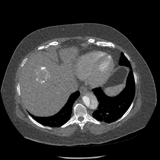 Aortic dissection - Stanford type B (Radiopaedia 88281-104910 A 75).jpg