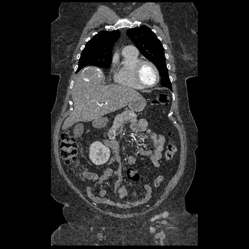 File:Aortic dissection - Stanford type B (Radiopaedia 88281-104910 B 14).jpg
