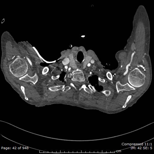 File:Aortic dissection with extension into aortic arch branches (Radiopaedia 64402-73204 B 42).jpg