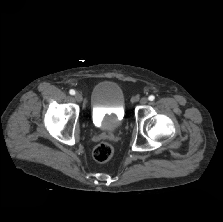 Aortic dissection with rupture into pericardium (Radiopaedia 12384-12647 A 85).jpg