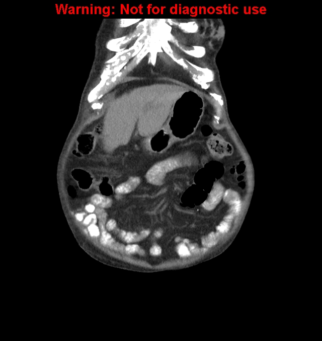 Aortic graft infection (Radiopaedia 44979-48907 non-contrast 8).jpg