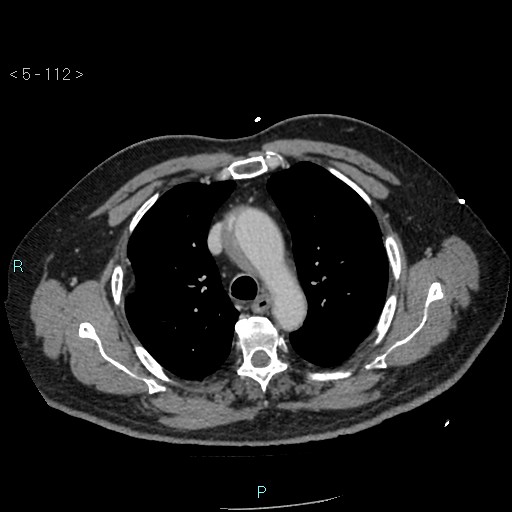 Aortic intramural hematoma (Radiopaedia 48463-53380 C 52).jpg