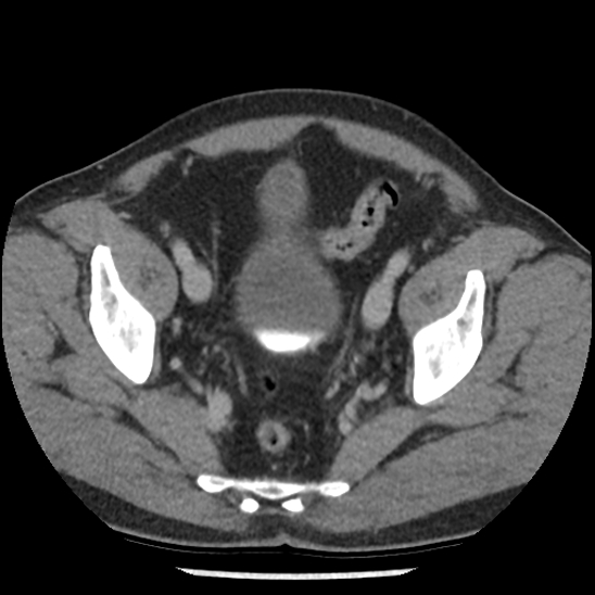 Aortic intramural hematoma (type B) (Radiopaedia 79323-92387 Axial C+ delayed 103).jpg