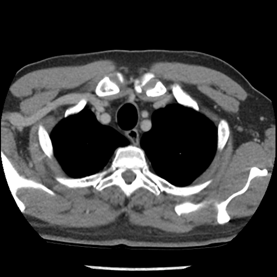 Aortic intramural hematoma (type B) (Radiopaedia 79323-92387 Axial C+ delayed 5).jpg
