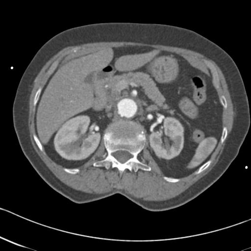 Aortic intramural hematoma from penetrating atherosclerotic ulcer (Radiopaedia 31137-31836 A 91).jpg