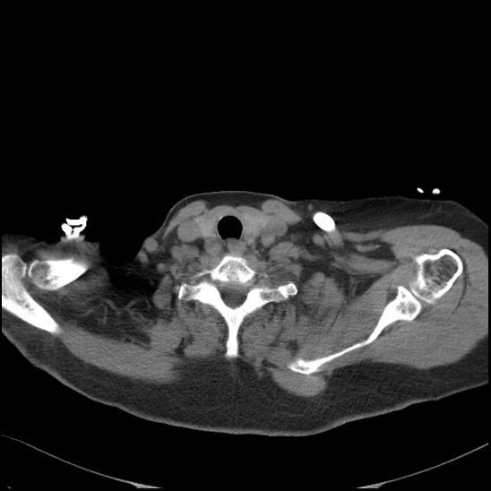 Aortic intramural hematoma with dissection and intramural blood pool (Radiopaedia 77373-89491 Axial non-contrast 9).jpg