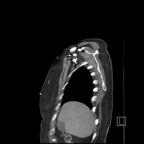 Aortic intramural hematoma with dissection and intramural blood pool (Radiopaedia 77373-89491 D 8).jpg