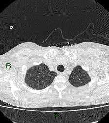File:Aortic valve endocarditis (Radiopaedia 87209-103485 Axial lung window 19).jpg