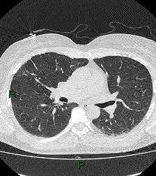 File:Aortic valve endocarditis (Radiopaedia 87209-103485 Axial lung window 49).jpg