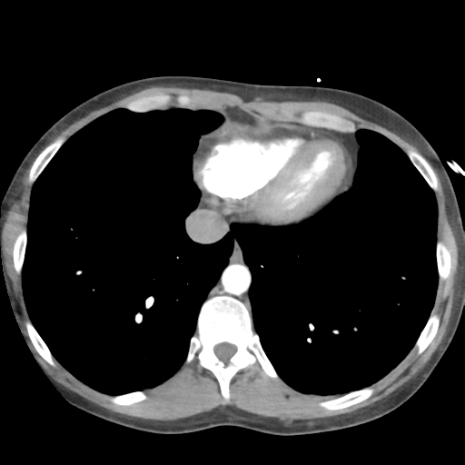 Aortic valve non-coronary cusp thrombus (Radiopaedia 55661-62189 B 39).png