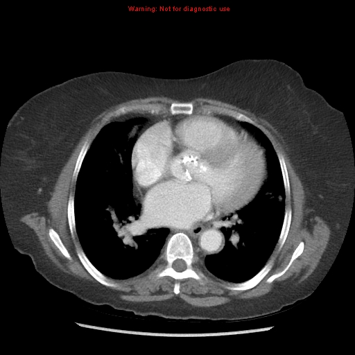 File:Aortic valve stenosis (Radiopaedia 14480-14423 C 8).jpg