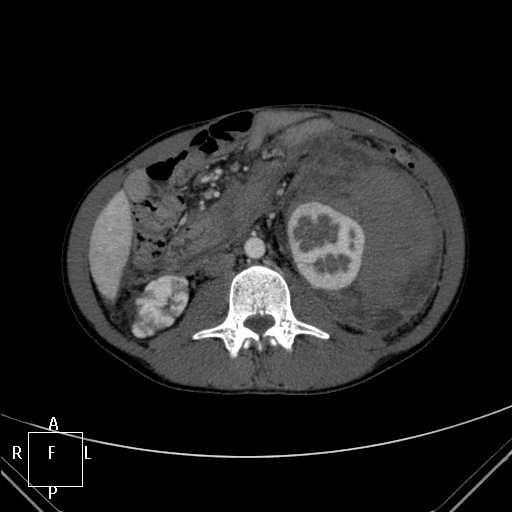 File:Aorto-left renal vein fistula (Radiopaedia 45534-49628 A 31).jpg