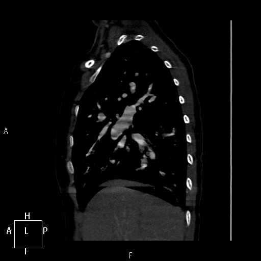 File:Aortopulmonary septal defect (Radiopaedia 41990-45013 Sagittal C+ CTPA 48).jpg