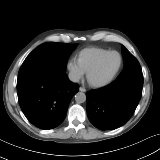 Apical pulmonary metastasis (Radiopaedia 46338-50754 B 46).png