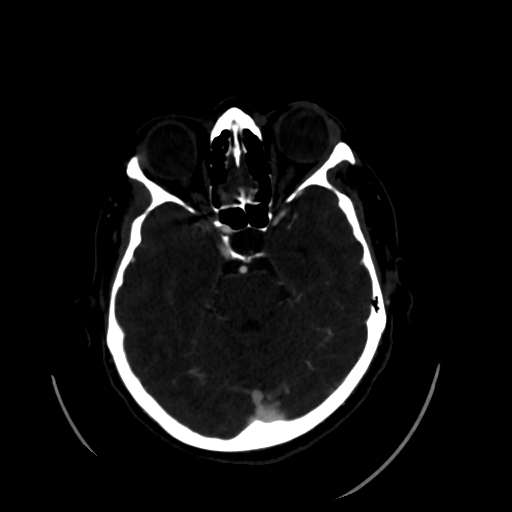 Aplasia of the internal carotid artery (Radiopaedia 61082-68960 A 24).jpg