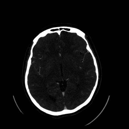 Aplasia of the internal carotid artery (Radiopaedia 61082-68960 A 34).jpg