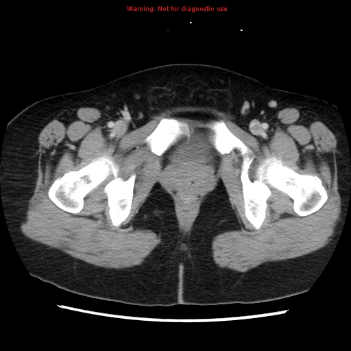 Appendiceal mucinous cystadenoma (Radiopaedia 8263-9111 Axial liver window 81).jpg