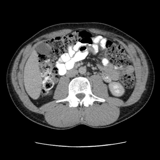 File:Appendicitis complicated by post-operative collection (Radiopaedia 35595-37113 A 34).jpg