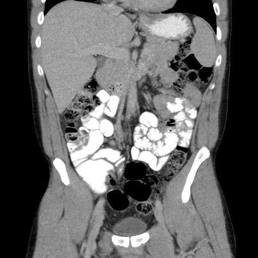 File:Appendicitis complicated by post-operative collection (Radiopaedia 35595-37113 B 24).jpg