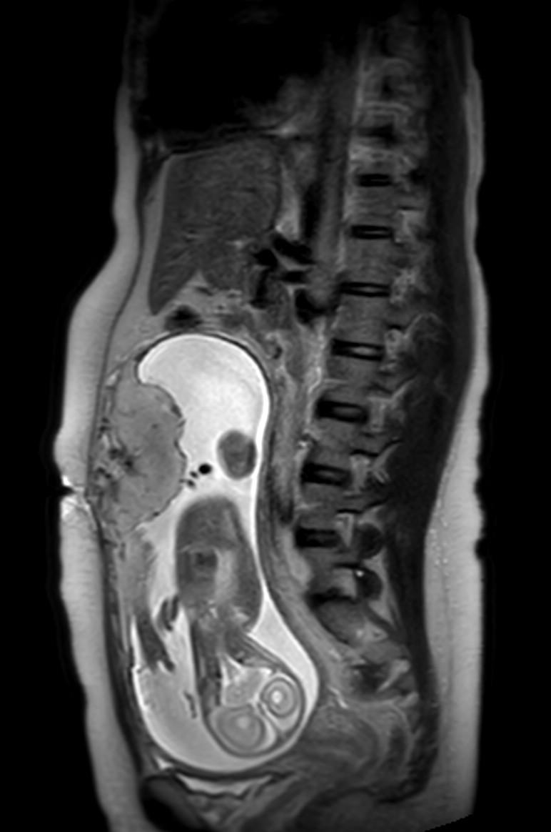 Appendicitis in gravida (MRI) (Radiopaedia 89433-106395 Sagittal T2 30).jpg