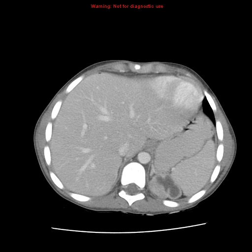 File:Appendicitis with phlegmon (Radiopaedia 9358-10046 A 15).jpg