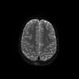 Arachnoid cyst - middle cranial fossa (Radiopaedia 67671-77088 Axial DWI 48).jpg