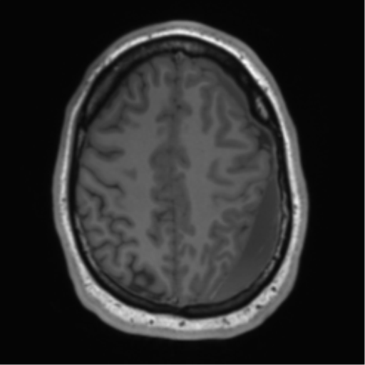 File:Arachnoid cyst with subdural hematoma (Radiopaedia 85892-101743 Axial T1 65).png