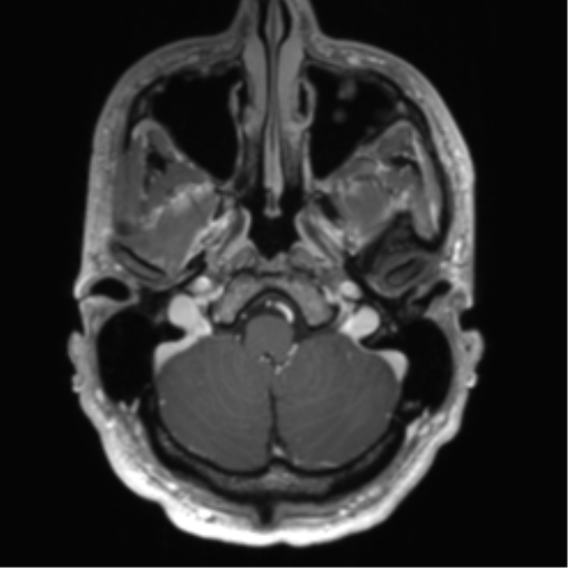File:Arachnoid cyst with subdural hematoma (Radiopaedia 85892-101743 Axial T1 C+ 17).png