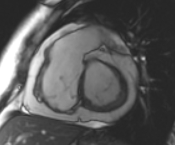 File:Arrhythmogenic right ventricular cardiomyopathy (Radiopaedia 69431-79307 Short axis cine 165).jpg