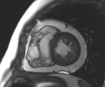 File:Arrhythmogenic right ventricular cardiomyopathy (Radiopaedia 69431-79307 Short axis cine 89).jpg